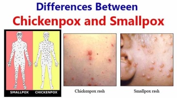 Differences-Between-Chickenpox-and-Smallpox